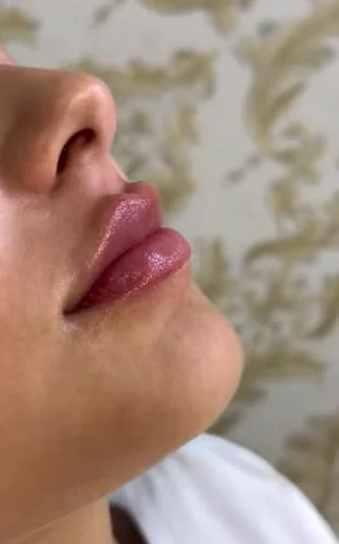 Detalhe de preenchimento labial com aparência natural